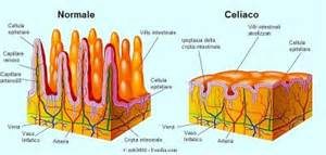 Celiachia villi intestinali